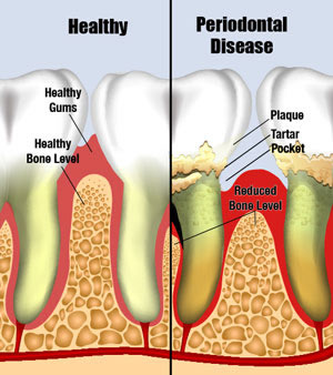 http://liimplantperio.com/_patiented/periodontal_disease.jpg